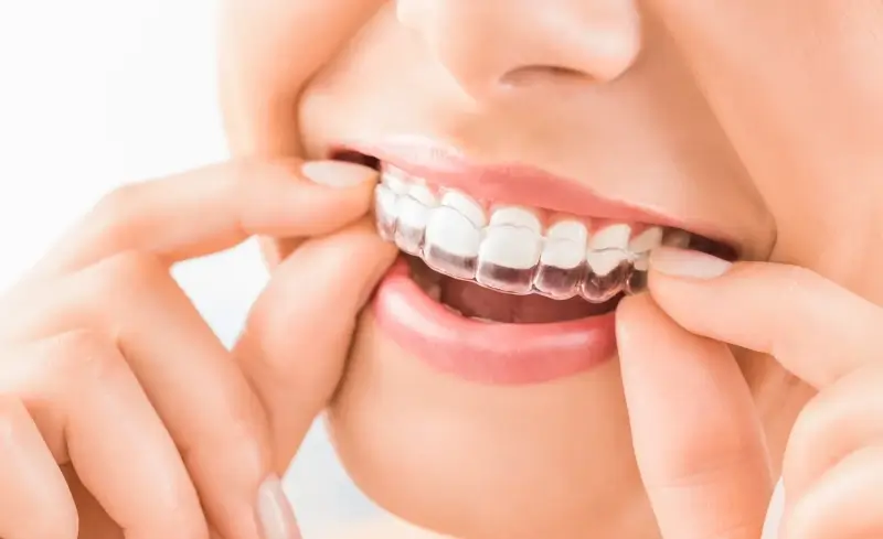 Co można jeść w Invisalign?