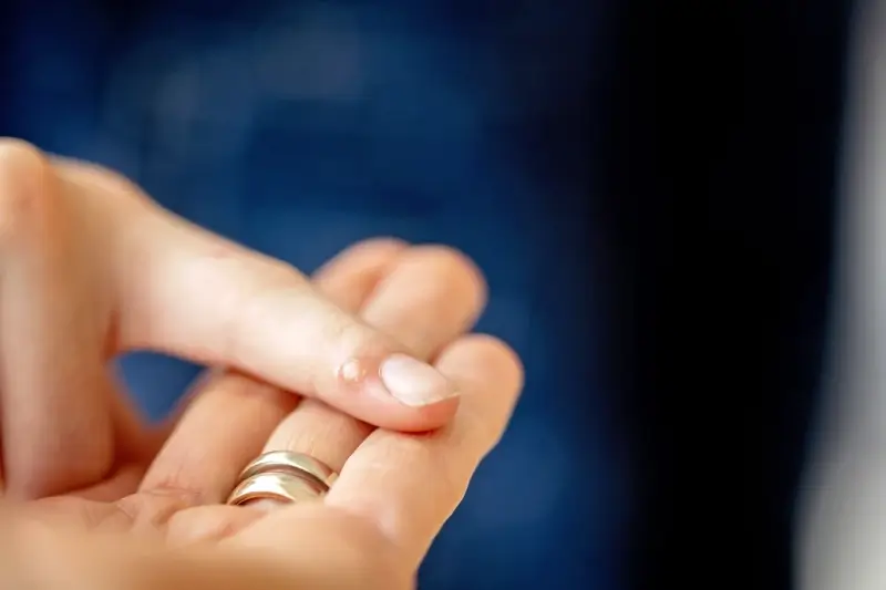 Ile trwa leczenie kurzajki?